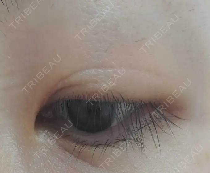 二重切開 ティーズクリニック DAY 186 メイン用