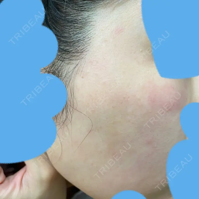 ピコレーザートーニング（美白・肝斑） UB CLINIC銀座 DAY 13 メイン用