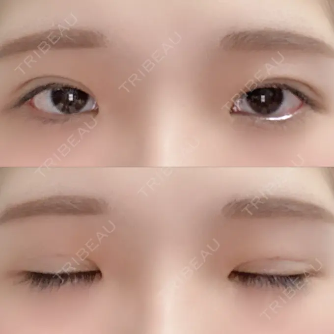 二重埋没 湘南美容クリニック 赤坂見附院 DAY 22 メイン用