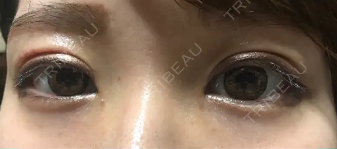 二重切開 きくな湯田眼科 DAY 9 メイン用