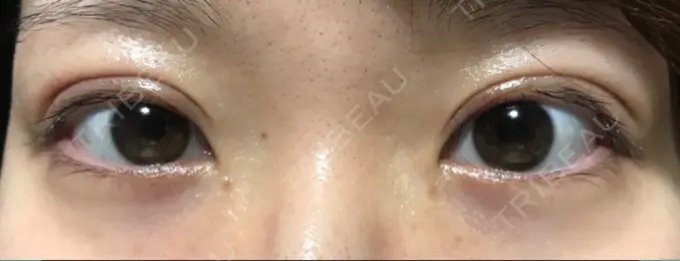 二重切開 きくな湯田眼科 DAY 10 メイン用