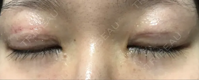 二重切開 きくな湯田眼科 DAY 10 メイン用