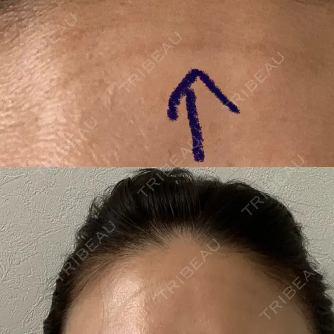 額を丸く / シワ取りボトックス 銀座3丁目・BANNAI美容クリニック DAY 23 メイン用