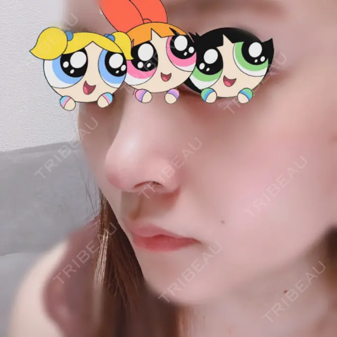 軟骨移植 BIANCA銀座 DAY 11 メイン用