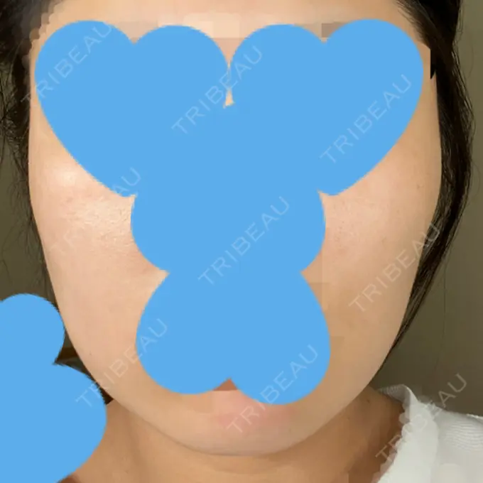 脂肪溶解注射（顔） ビクアスクリニック DAY 22 メイン用