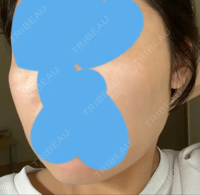 脂肪溶解注射（顔） ビクアスクリニック DAY 22 メイン用