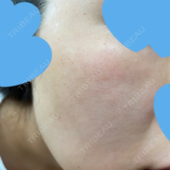 ピコレーザートーニング（美白・肝斑） UB CLINIC銀座 DAY 17 メイン用