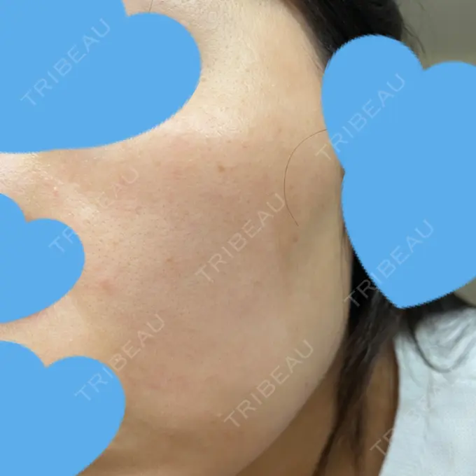 ピコレーザートーニング（美白・肝斑） UB CLINIC銀座 DAY 17 メイン用