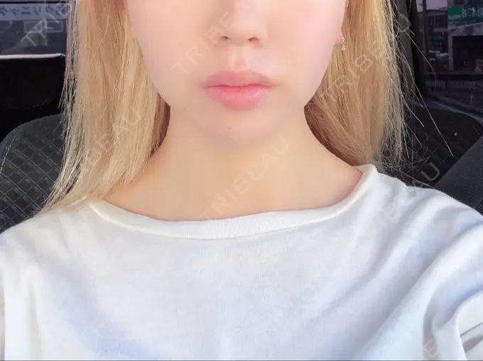 糸リフト / バッカルファット除去 / ボトックス（エラ・小顔） TCB東京中央美容外科 堺院 DAY 11 メイン用