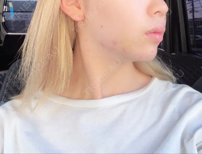 糸リフト / バッカルファット除去 / ボトックス（エラ・小顔） TCB東京中央美容外科 堺院 DAY 11 メイン用