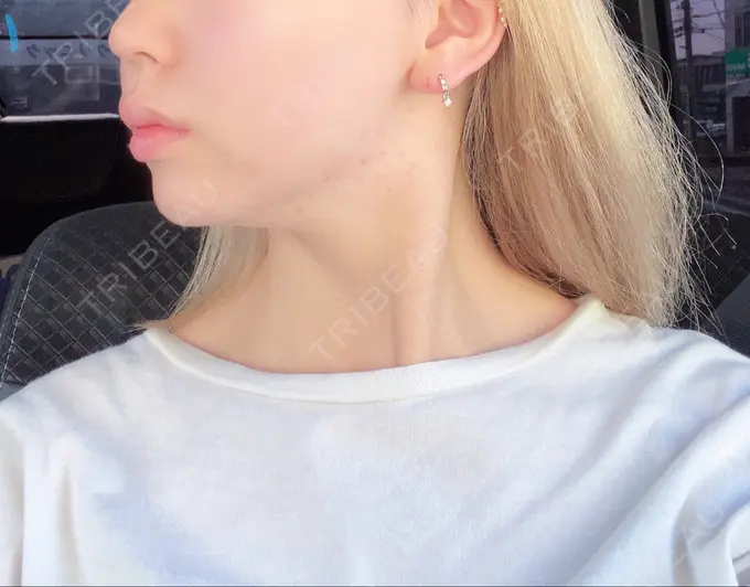 糸リフト / バッカルファット除去 / ボトックス（エラ・小顔） TCB東京中央美容外科 堺院 DAY 11 メイン用