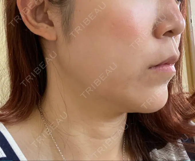 糸リフト 大阪TAクリニック DAY 29 メイン用