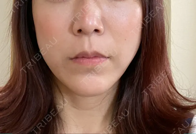 糸リフト 大阪TAクリニック AFTER メイン用