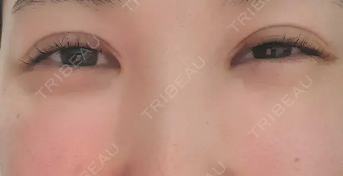 シワ取りボトックス CLASSY 仙台美容外科・美容皮膚科 AFTER メイン用