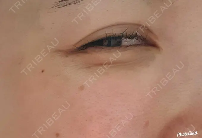 シワ取りボトックス CLASSY 仙台美容外科・美容皮膚科 DAY 83 メイン用