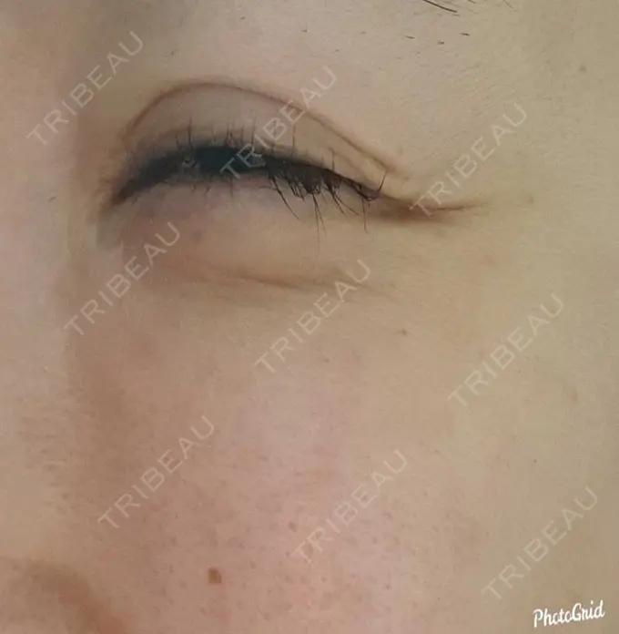 シワ取りボトックス CLASSY 仙台美容外科・美容皮膚科 DAY 83 メイン用