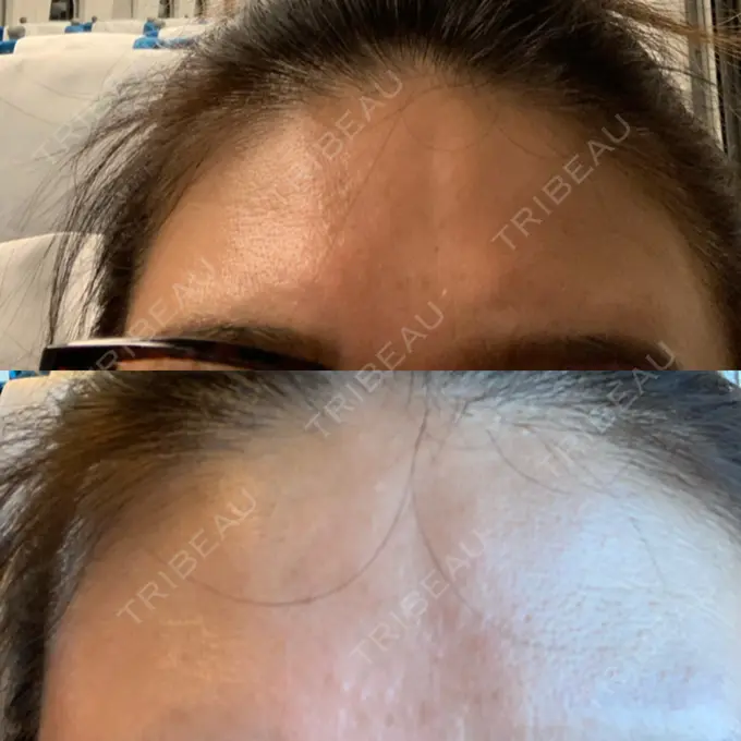 額を丸く / シワ取りボトックス 銀座3丁目・BANNAI美容クリニック DAY 24 メイン用