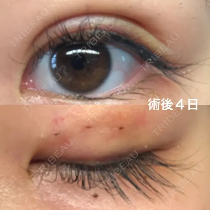 二重埋没 湘南美容クリニック 京都院 DAY 4 メイン用