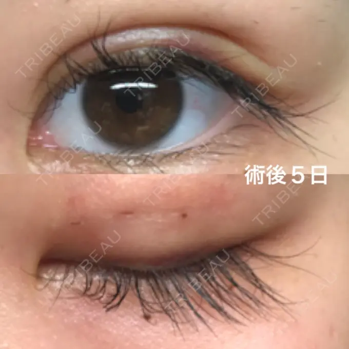 二重埋没 湘南美容クリニック 京都院 DAY 5 メイン用