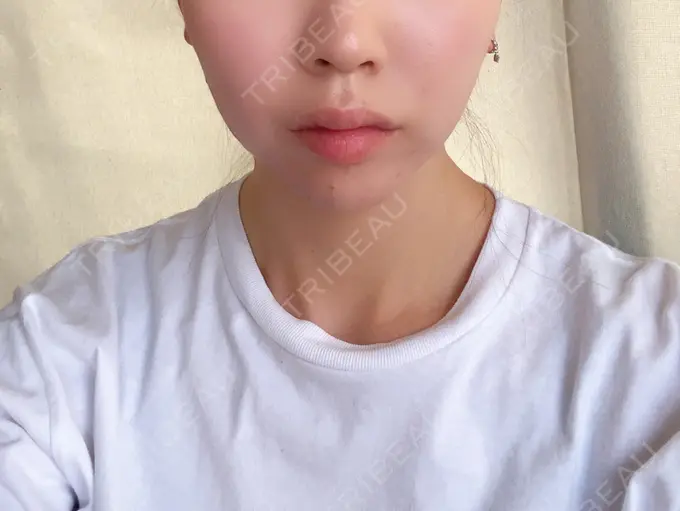 糸リフト / バッカルファット除去 / ボトックス（エラ・小顔） TCB東京中央美容外科 堺院 DAY 12 メイン用