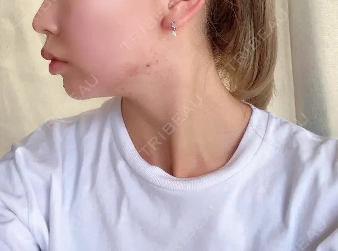 糸リフト / バッカルファット除去 / ボトックス（エラ・小顔） TCB東京中央美容外科 堺院 DAY 12 メイン用