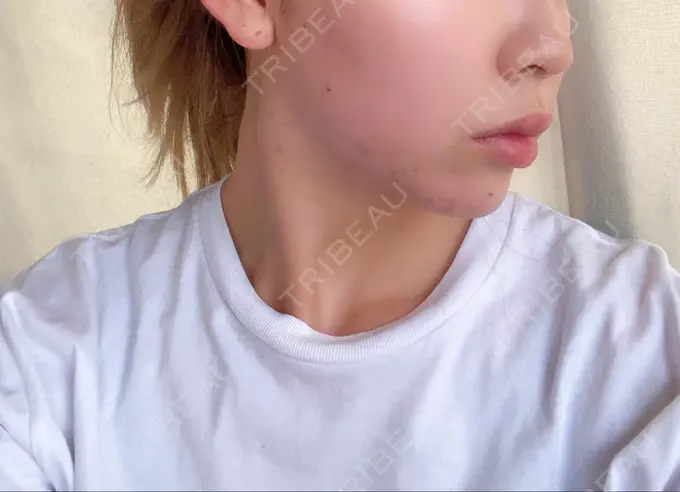 糸リフト / バッカルファット除去 / ボトックス（エラ・小顔） TCB東京中央美容外科 堺院 DAY 12 メイン用