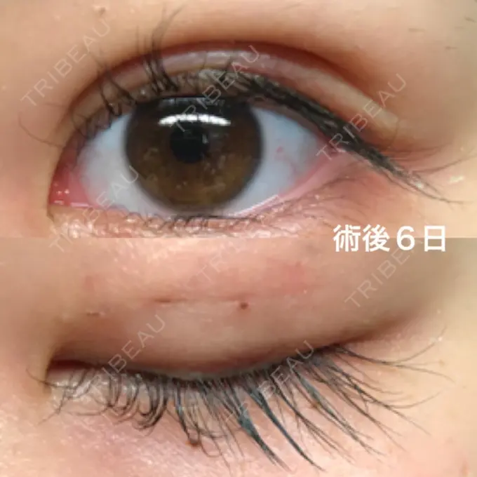 二重埋没 湘南美容クリニック 京都院 DAY 6 メイン用