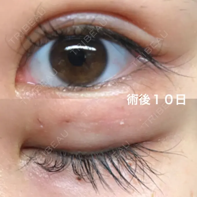 二重埋没 湘南美容クリニック 京都院 DAY 10 メイン用