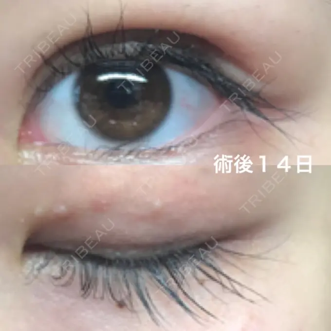 二重埋没 湘南美容クリニック 京都院 DAY 14 メイン用