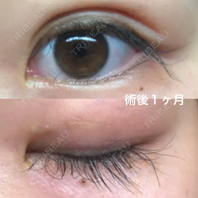 二重埋没 湘南美容クリニック 京都院 DAY 31 メイン用