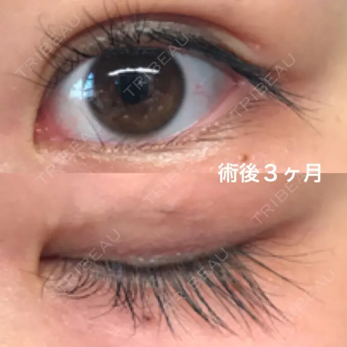 二重埋没 湘南美容クリニック 京都院 AFTER メイン用