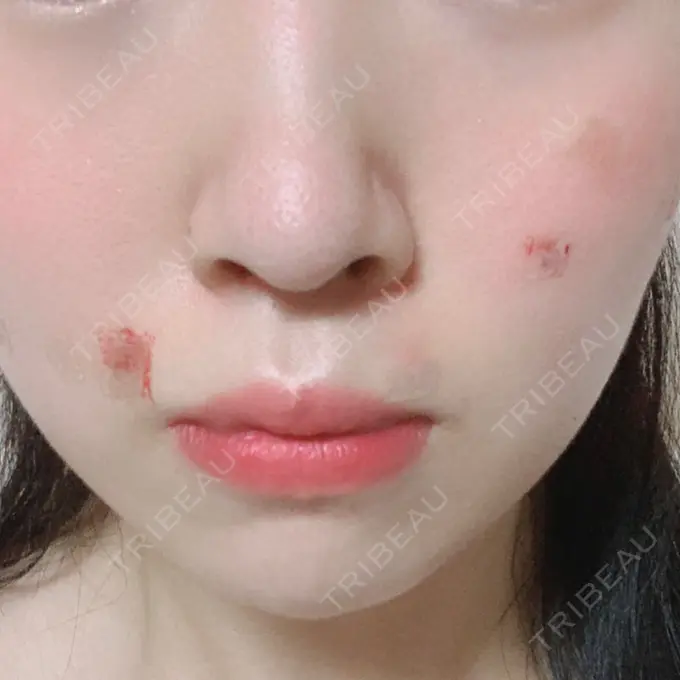 ほくろ・いぼ切除（肌） 品川スキンクリニック大宮院 DAY 0 メイン用