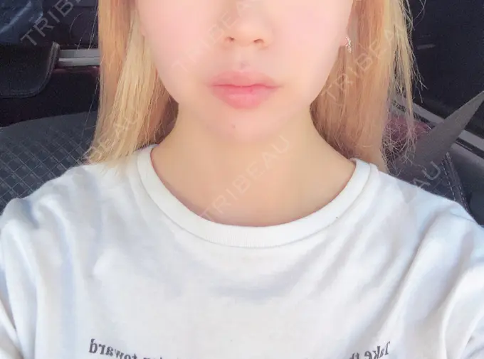 糸リフト / バッカルファット除去 / ボトックス（エラ・小顔） TCB東京中央美容外科 堺院 AFTER メイン用