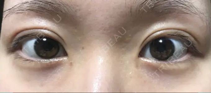 二重切開 きくな湯田眼科 DAY 14 メイン用