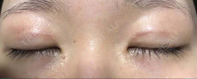 二重切開 きくな湯田眼科 DAY 14 メイン用