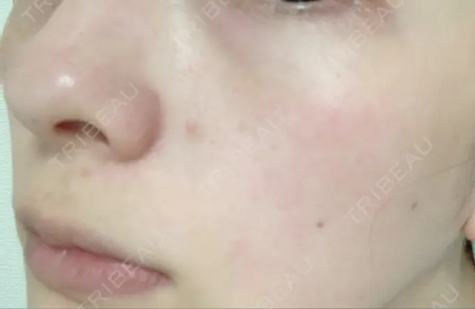 シミ取りレーザー / 美白レーザー よつば会クリニック 森ノ宮院 AFTER メイン用