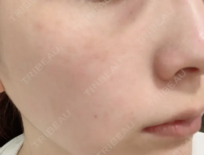 シミ取りレーザー / 美白レーザー よつば会クリニック 森ノ宮院 DAY 82 メイン用