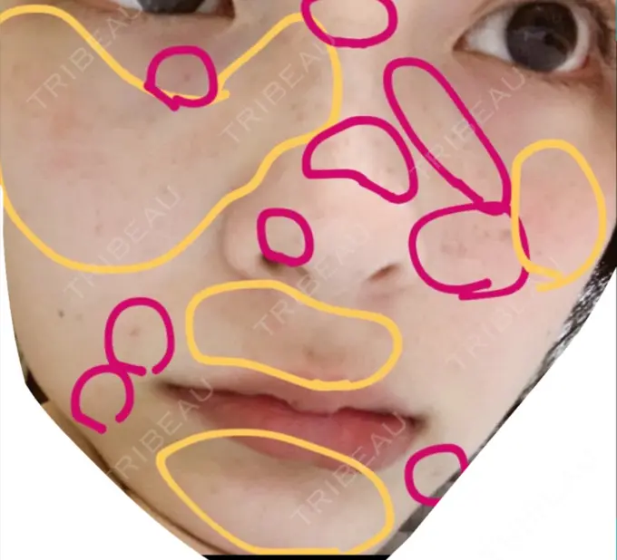 シミ取りレーザー / 美白レーザー よつば会クリニック 森ノ宮院 DAY 82 メイン用