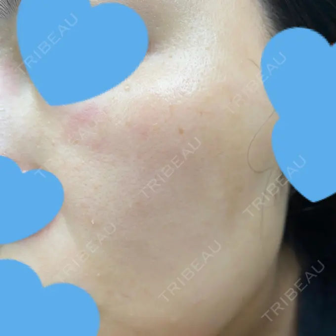 ピコレーザートーニング（美白・肝斑） UB CLINIC銀座 DAY 20 メイン用