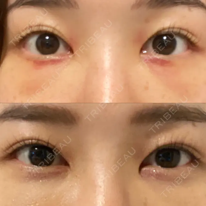 クマ治療 / 下まぶたの脂肪取り ルラ美容クリニック 高田馬場院 DAY 3 メイン用