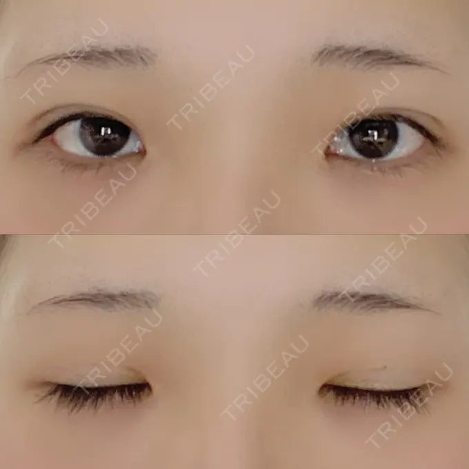 二重埋没 湘南美容クリニック 赤坂見附院 DAY 31 メイン用