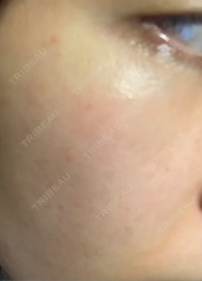 ハイフ（顔） / イオン導入 湘南美容クリニック 名古屋栄院 DAY 3 メイン用