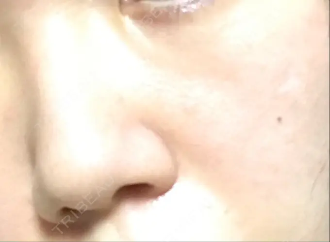 ハイフ（顔） / イオン導入 湘南美容クリニック 名古屋栄院 DAY 1 メイン用