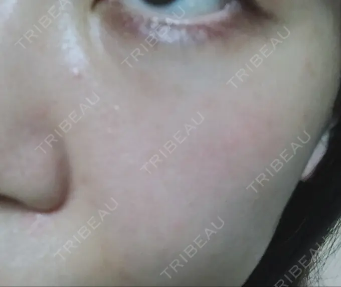 ハイフ（顔） / イオン導入 湘南美容クリニック 名古屋栄院 DAY 7 メイン用