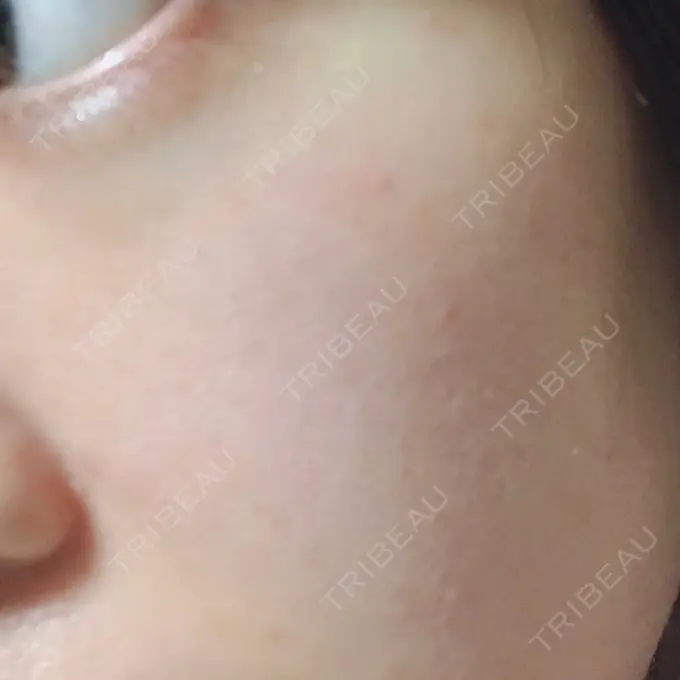 ハイフ（顔） / イオン導入 湘南美容クリニック 名古屋栄院 DAY 7 メイン用