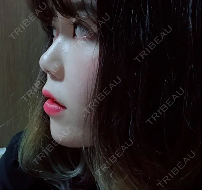 ハイフ（顔） / イオン導入 湘南美容クリニック 名古屋栄院 DAY 14 メイン用