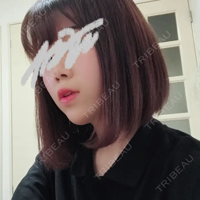 ハイフ（顔） / イオン導入 湘南美容クリニック 名古屋栄院 DAY 14 メイン用