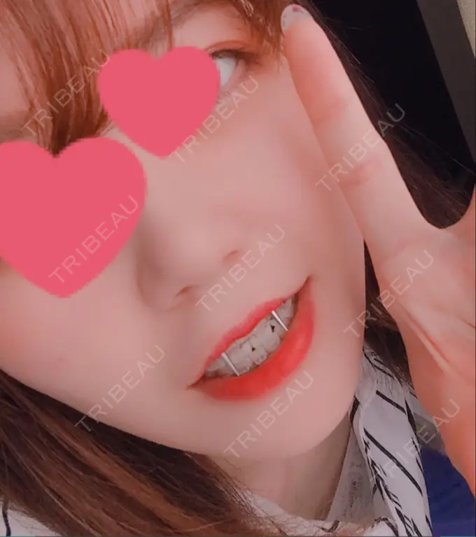 ハイフ（顔） / イオン導入 湘南美容クリニック 名古屋栄院 AFTER メイン用