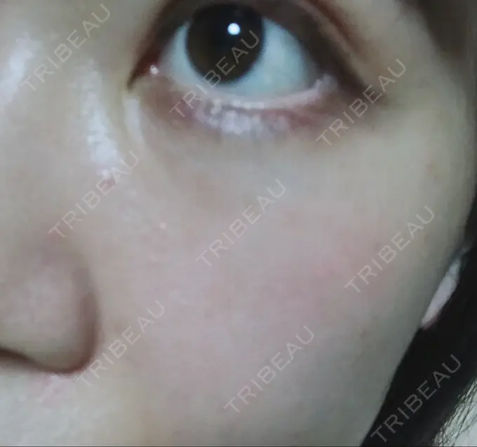 ハイフ（顔） / イオン導入 湘南美容クリニック 名古屋栄院 DAY 14 メイン用