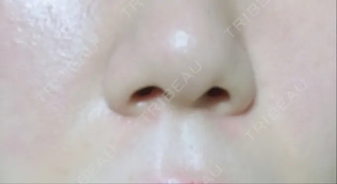 ハイフ（顔） / イオン導入 湘南美容クリニック 名古屋栄院 DAY 14 メイン用